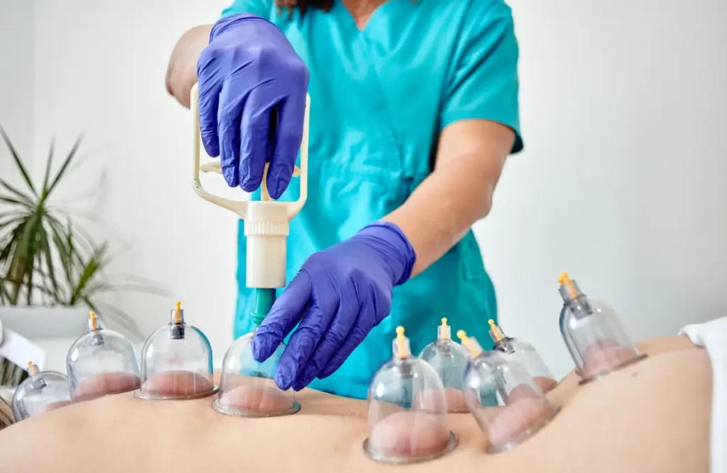Hijama Cupping Therapy