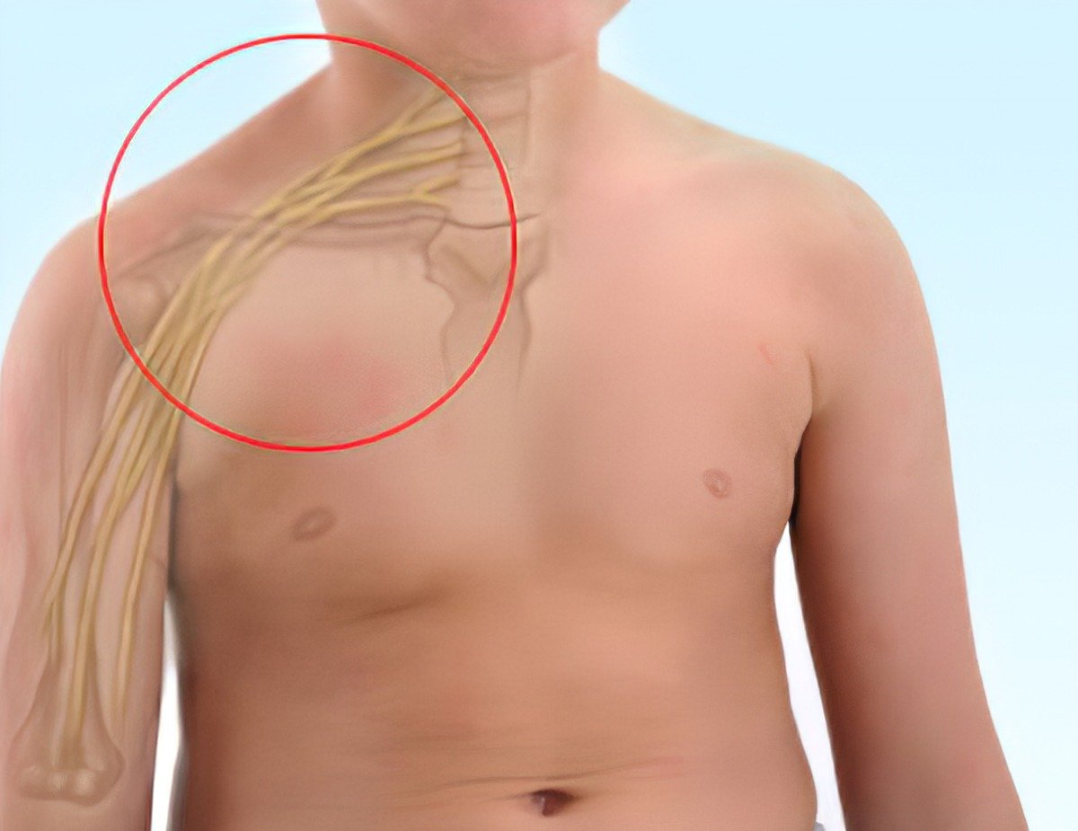 Brachial Plexus Therapy