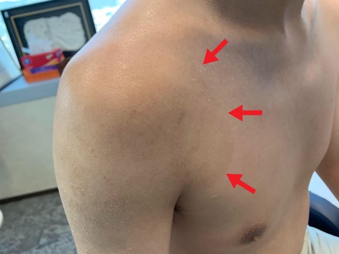 Thoracic Outlet Syndrome Bhopal